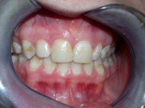 Before. Note the pitting and staining. Front to teeth were covered with an old white filling.