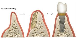 bone graft