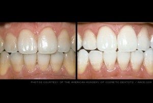 teeth whitening before and after