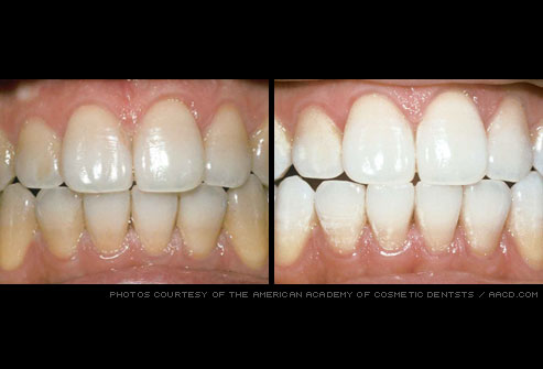 Teeth whitening can be performed by a dentist office, or in the 