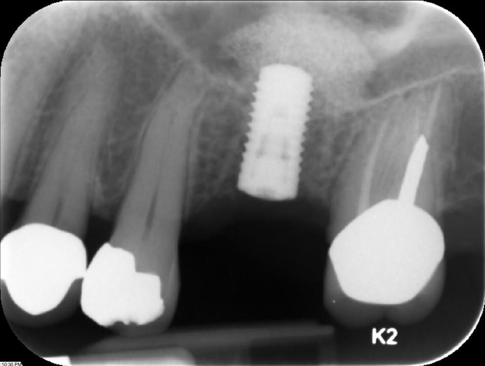 sinus lift