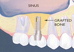 sinus lift