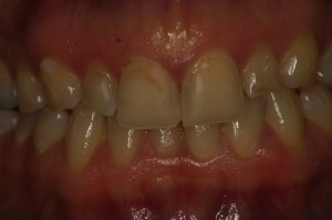 cosmetic dentistry needed stained and chipped teeth with old fillings