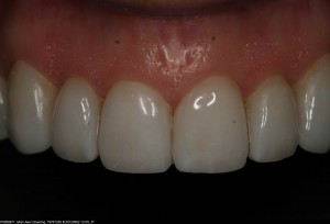 close up cosmetic dental porcelain crown
