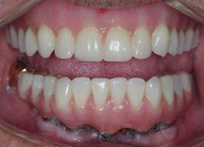 implants dental permanent implant dentures teeth denture dentist options removable attached non allow mouth
