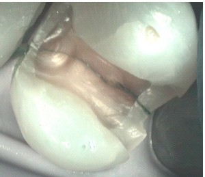 cracked tooth syndrome jerusalem dentist