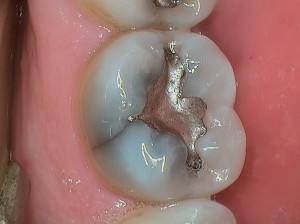 cracked tooth syndrome Jerusalem dentist
