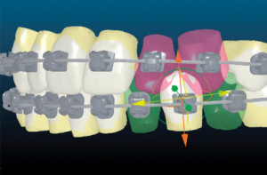 invisilign orthodontics
