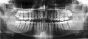 יישור שיניים orthodontics panoramic