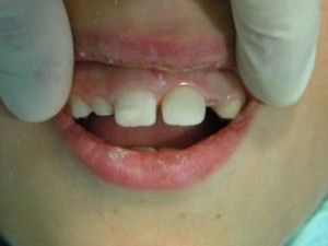 boken tooth repair