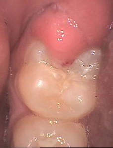 pericoronitis