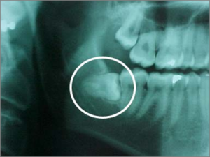 Impacted wisdom tooth