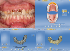 CEREC before treatment