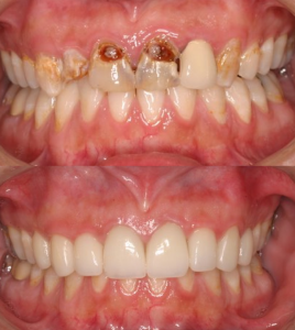 CEREC AFTER