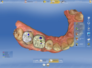 Cerec occlusion computerized dentistry