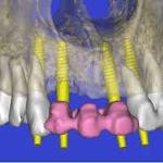 guided implant surgery