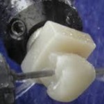 cerec blocks