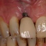 implant esthetics