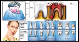 toothache