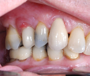 Dental implant problems peri implantitis