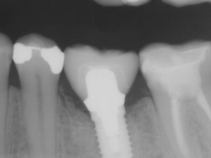 Dental implant problems