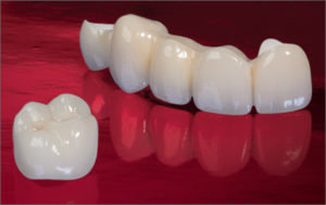 zirconia crown