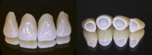 Advantages and Disadvantages of Zirconia Crowns