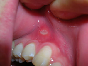 laser treatment for canker sores