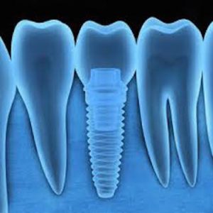 the cost of dental implants