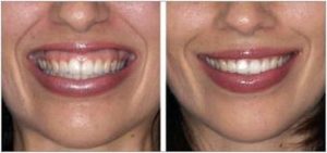 Laser Esthetic Gum Recontouring