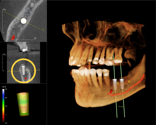 dental ct