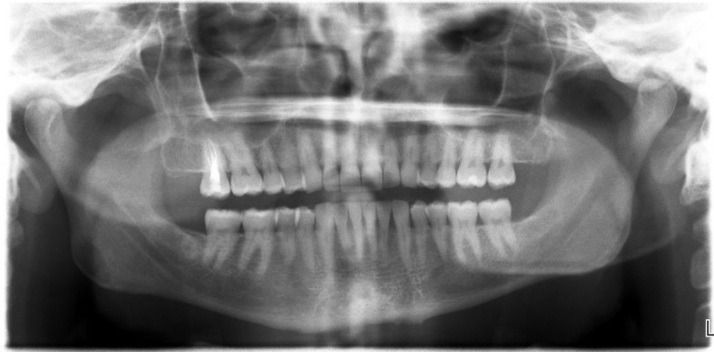 panoramic xray