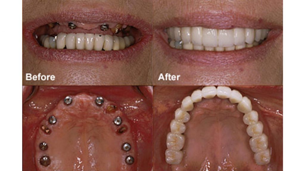 dental-implants Before and after