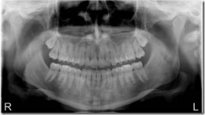 צילום פנורמי לשיניים בהריון