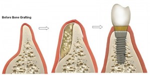השתלות שיניים והשתלת עצם