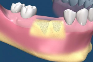 השתלת עצם לקראת השתלות שיניים