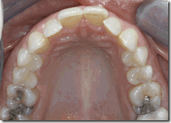 שיקום ותיקון שיניים עקומות על ידי כתרי חרסינה