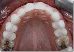 שיקום ותיקון שיניים עקומות על ידי כתרי חרסינה -אחרי
