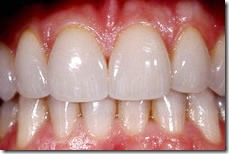 תיקון הרווח אחרי הדבקת ציפויי חרסינה לשיניים 