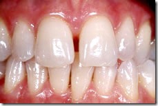 רווח לפני הדבקת ציפויי חרסינה לשיניים 