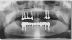 השתלות שיניים וכתרים