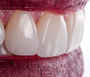 Dental Porcelains and the aesthetic balance