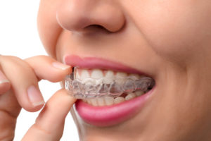 dental orthodontic aligners