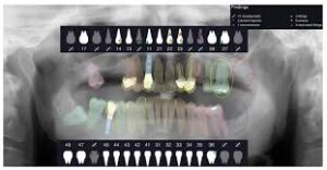 Artificial Intelligence in Dentistry segmentation